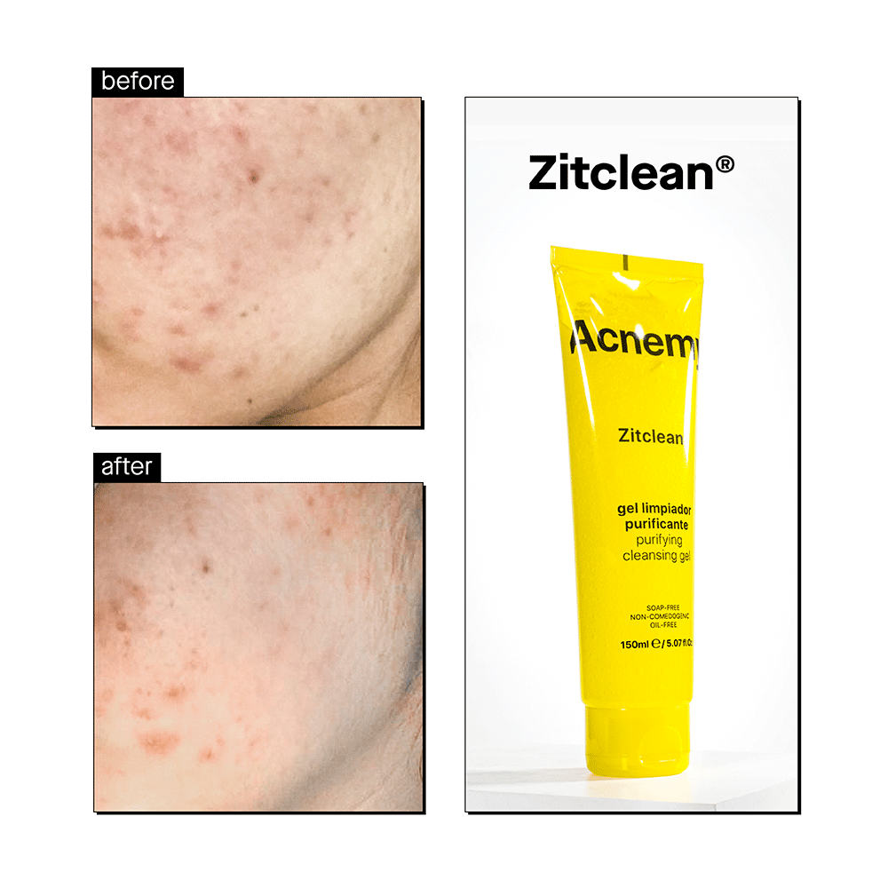 Bild: Acnemy Zitclean Reinigungsgel Purifying 